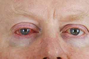 Chlamydien können im Auge ein Trachom oder Bindehautentzündung auslösen.