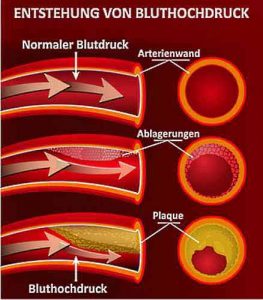 Durch eine Verengung der Arterien entsteht Bluthochdruck.