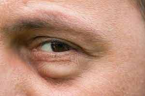 Geschwollene Augenlider zählen zu den möglichen Symptomen einer Schilddrüsenunterfunktion.