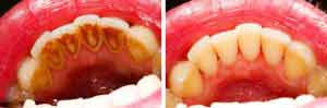 Plaque und Zahnstein können Mundgeruch verursachen.