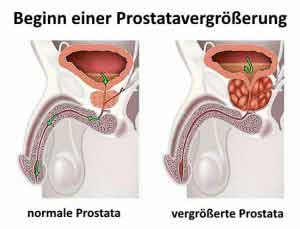 Eine Vergrößerung der Prostata engt den Harnleiter ein und führt zu Problemen beim Urinieren.