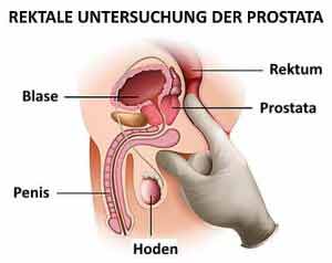Das Abtasten der Prostata dient der Prostatakrebs-Vorsorge.