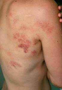 Entzündungen und Eiter sind Symptome einer bakteriellen Infektion.
