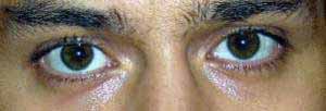Pupillenverengung nach Einnahme von 150 mg Tramadol