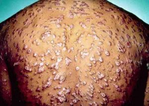 Hautveränderungen sind auffällige Syphilis Symptome.