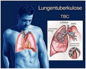 Tuberkulose befällt häufig die Lungen, kann aber auch andere Organe schädigen.