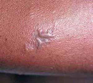 Hautläsionen können ein Anzeichen für eine Gonorrhoe-Infektion sein.