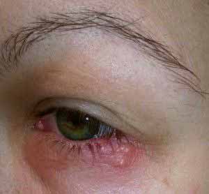 Eine Herpesinfektion der Augen kann bis zur Erblindung führen.