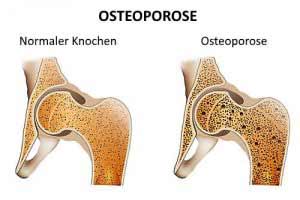 Östrogenmangel bringt ein erhöhtes Osteoporose-Risiko mit sich.