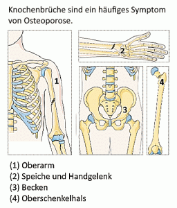 Durch Osteoporose brechen häufig Knochen an bestimmten Körperstellen.