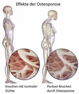 Osteoporose verändert die Knochenstruktur.