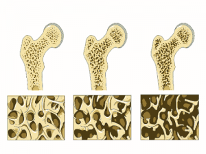 Bei Osteoporose werden die Knochen porös.